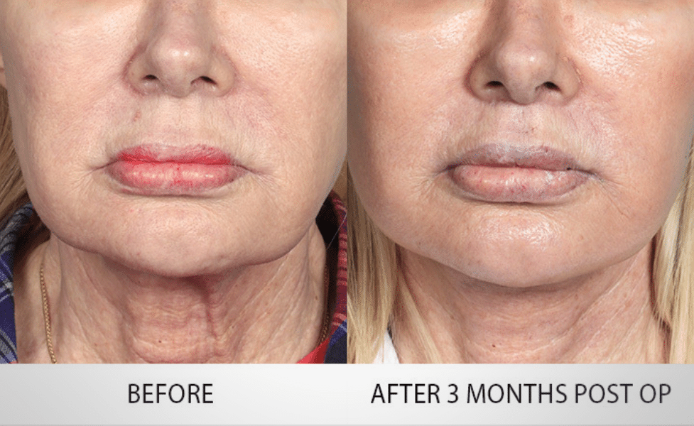 Lip Lift: Permanent Solutions for Lip Enhancement