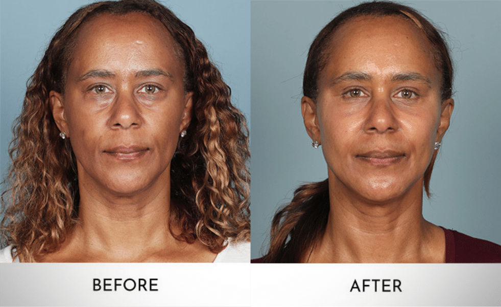 Lower Blepharoplasty: Techniques, Recovery, and Alternatives