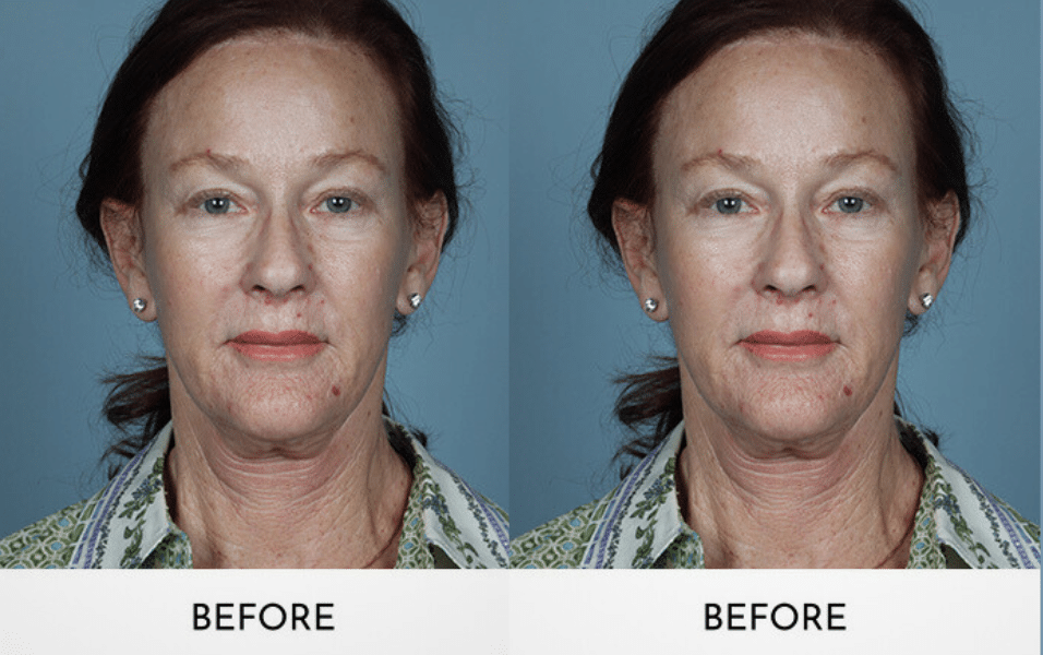 Choosing Between Mini and Full Facelifts- Surgeon's Advices