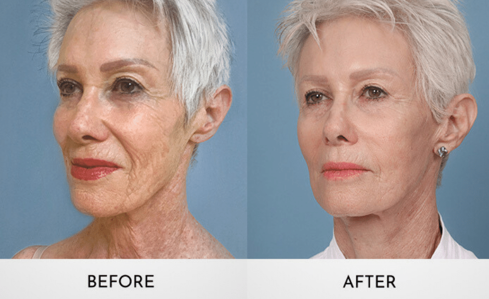 Choosing Between Mini and Full Facelifts- Surgeon's Advices