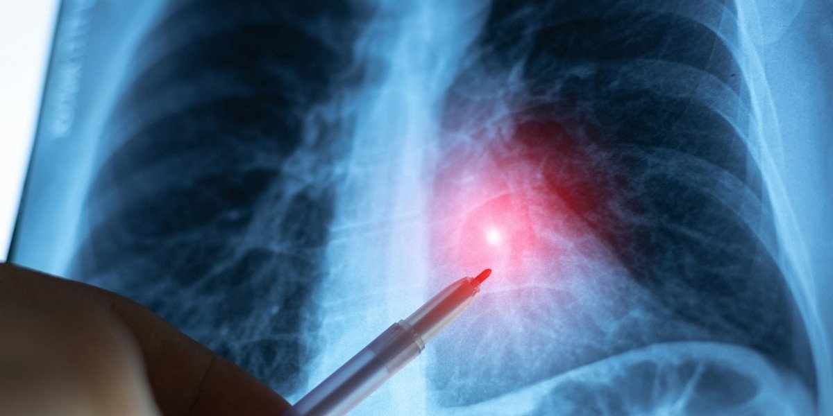 Lung Cancer Screening Why Early Detection Can Save Your Life